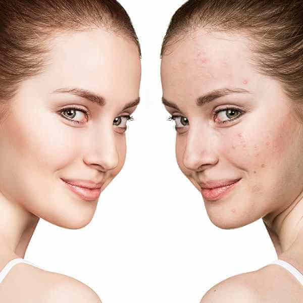 Salicylsäure: Effektiver Inhaltsstoff gegen Hautunreinheiten