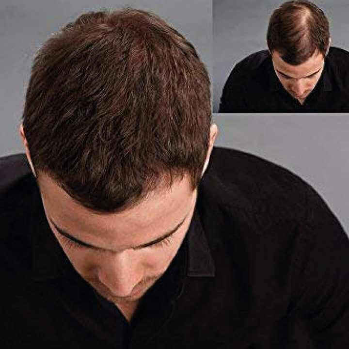 Before and after showing hair density improvement with KÖ-HAIR Fibers on a man's scalp.